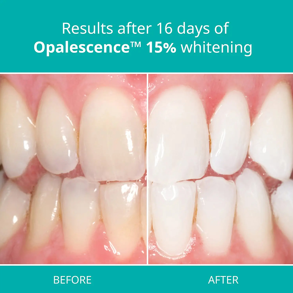 Opalescence Professional White – Teeth Whitening Gel Refills Bewertung und Preis