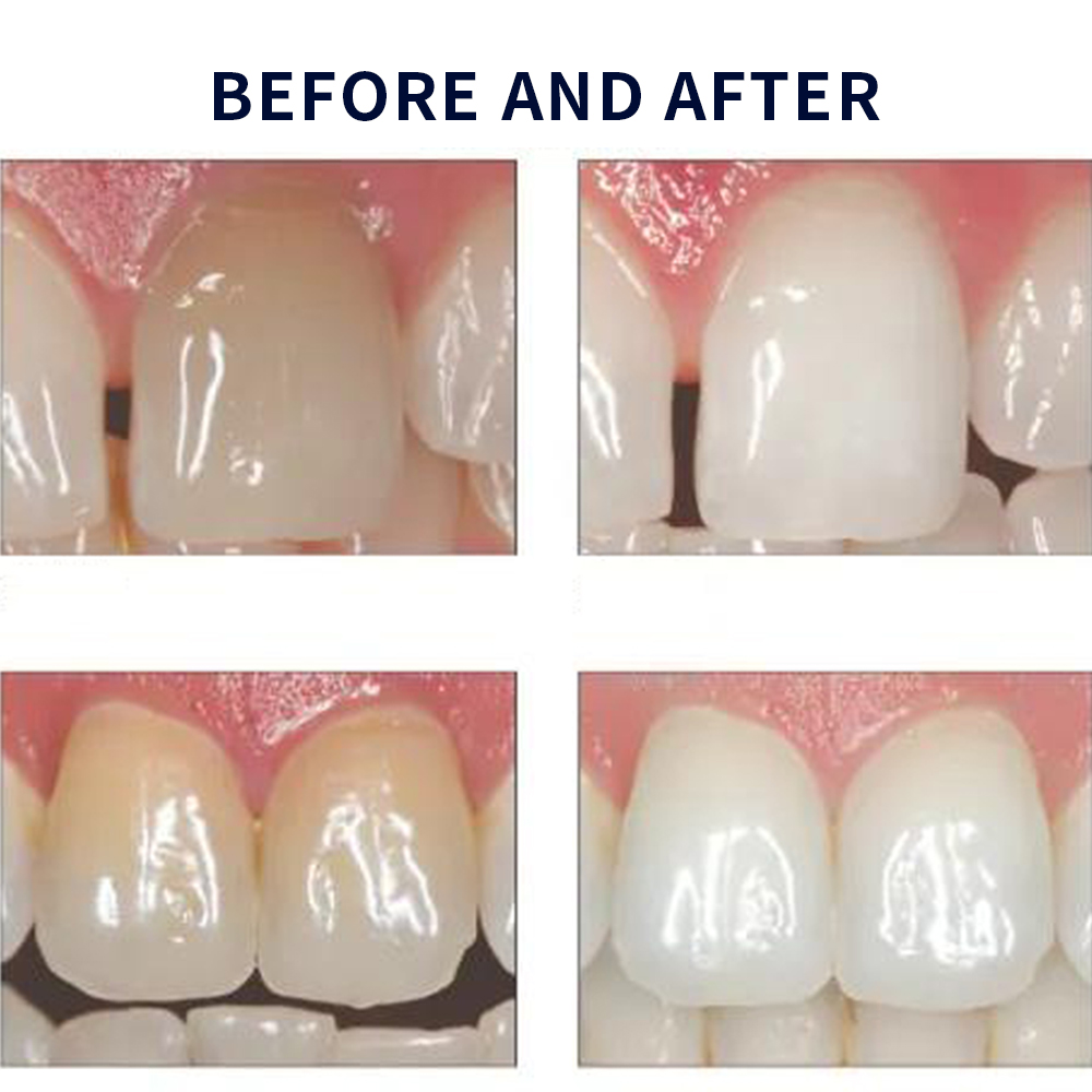 Opale scence White ning 1,2 pf – Teeth Whitening Flash Bewertung und Preis
