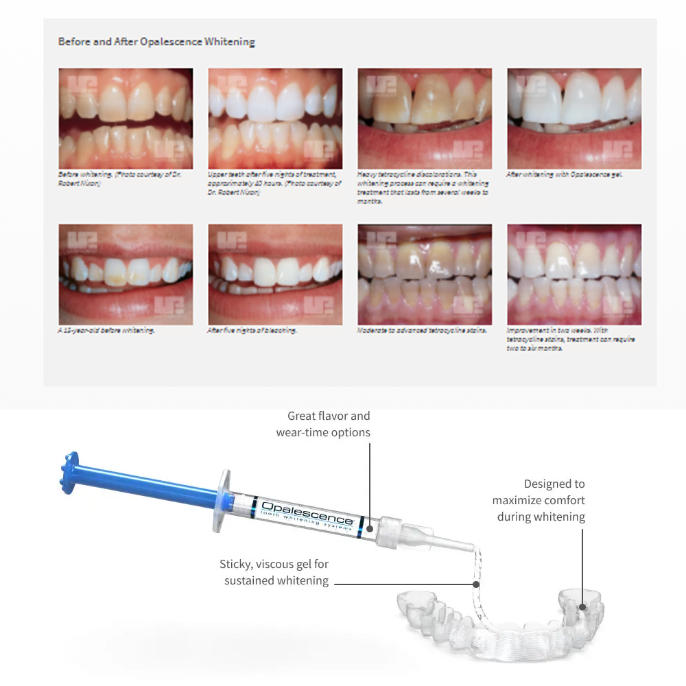 Opale scence White ning 1,2 pf – Teeth Whitening Flash Bewertung und Preis