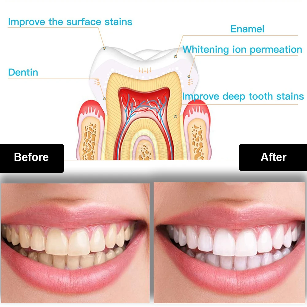 Dental Zahnaufhellung Kit Mini – Teeth Whitening Flash Bewertung und Preis