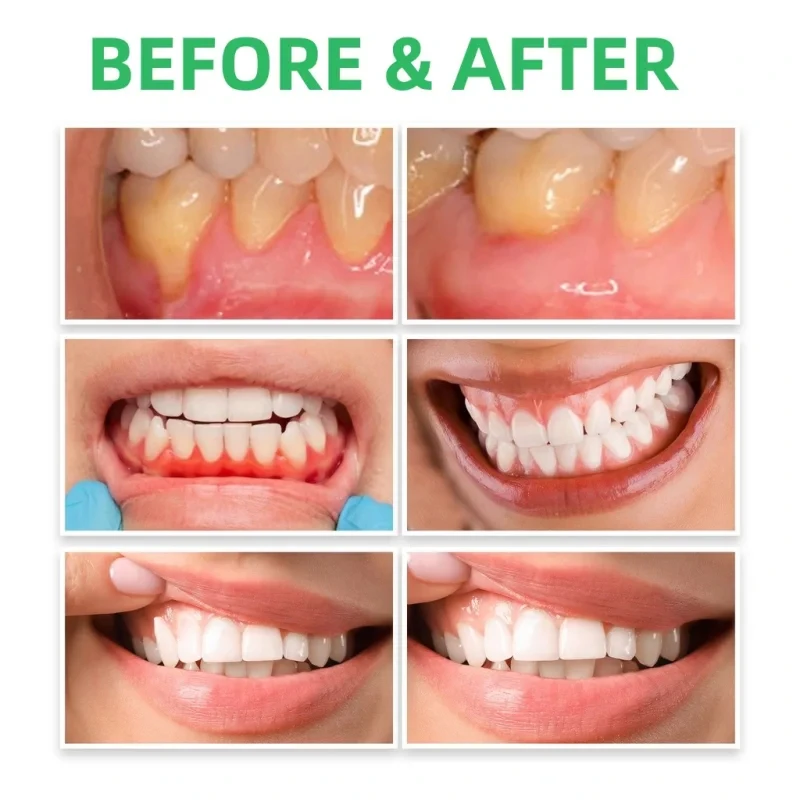 Zahnfleisch reparatur tropfen  – Teeth Whitening Paste Bewertung und Preis
